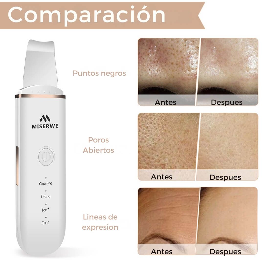 Miserwe: Limpiador Facial Ultrasónico 3 en 1
