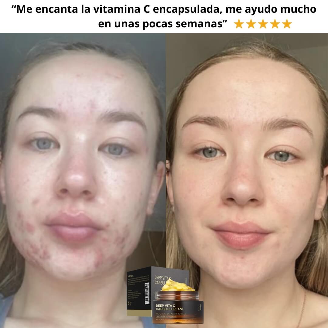 Dermacube®: Crema Antiacné con capsulas de Vitamina C
