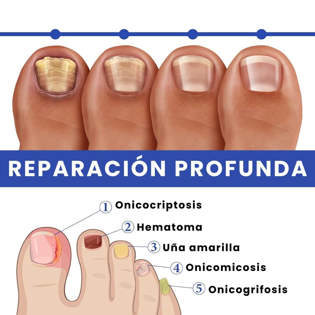 NailGuard®: Serum de Crecimiento y Reparación de Uñas